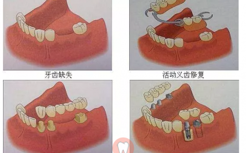 假牙种类假牙分为哪几种?