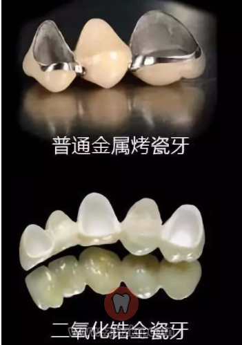 牙冠,牙套,是由惰性金属和烤瓷制成,内冠是一层金属材料,常见镍铬合金