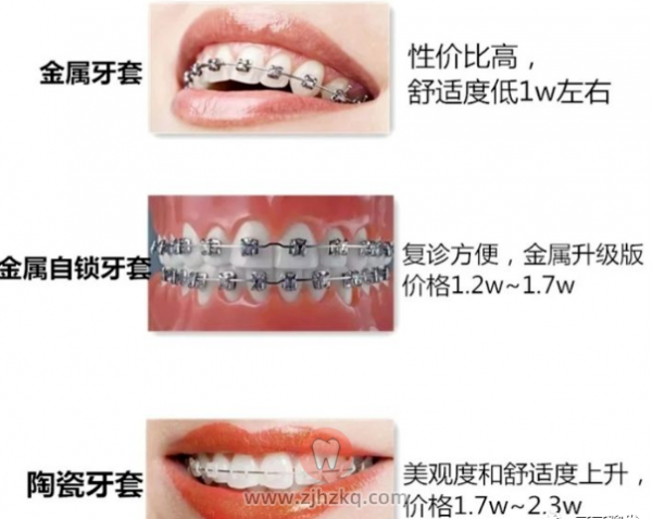 杭州牙套价格一般是多少钱一个?