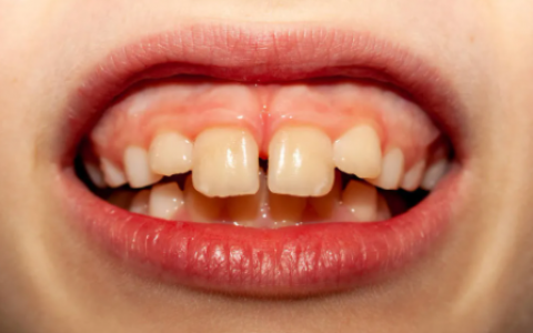 杭州龅牙正畸科普             龅牙是一种比较常见的牙齿