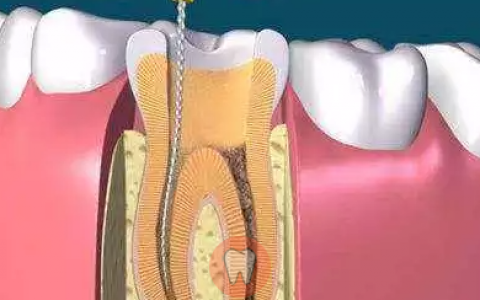 杭州根管治療