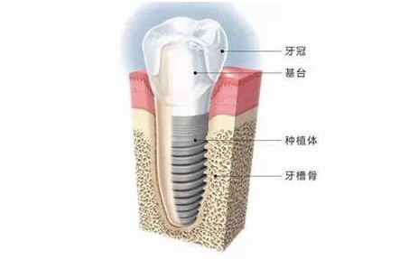 杭州一颗种植牙的费用价格