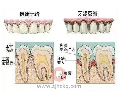 杭州口腔科普牙缝大怎么办