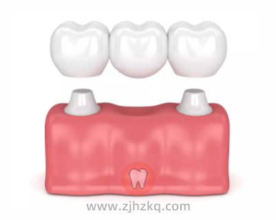 固定假牙固定桥搭桥牙图片照片