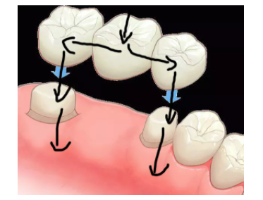 固定假牙固定桥搭桥牙图片照片