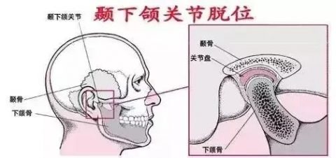 颞下颌关节脱位