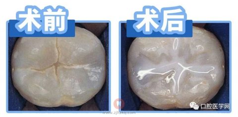 窝沟封闭前后照片对比图