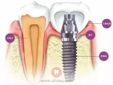 种植牙牢固吗会不会容易掉