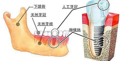 杭州种植牙收费项目