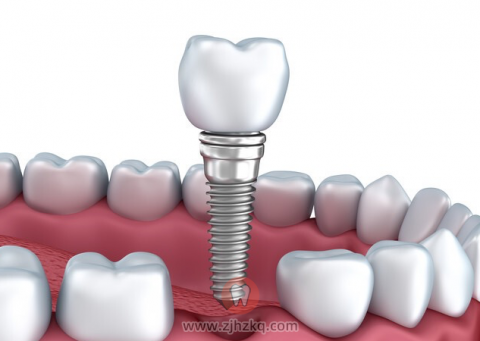 杭州种植牙医保是否可以报销
