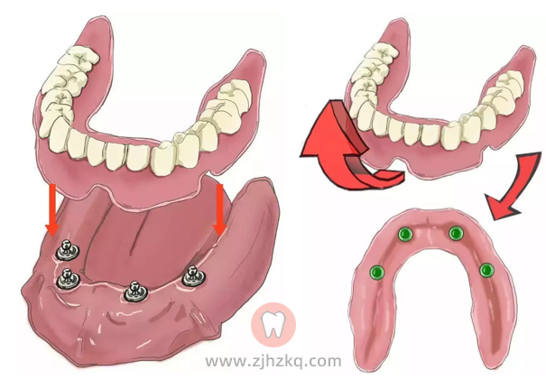 杭州老年人种植全口义齿（全口假牙）攻略