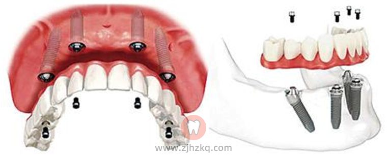 杭州老年人种植全口义齿（全口假牙）攻略
