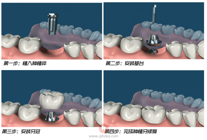 种植牙手术全流程图
