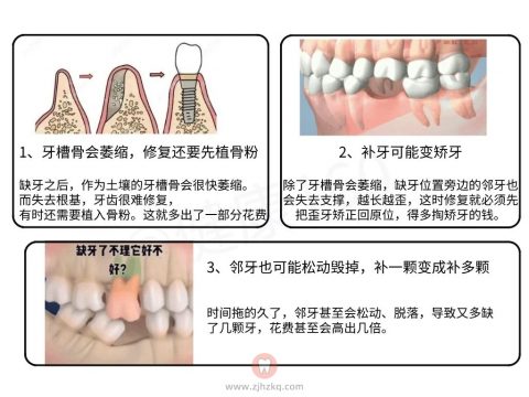 良心牙医忠告之缺牙危害