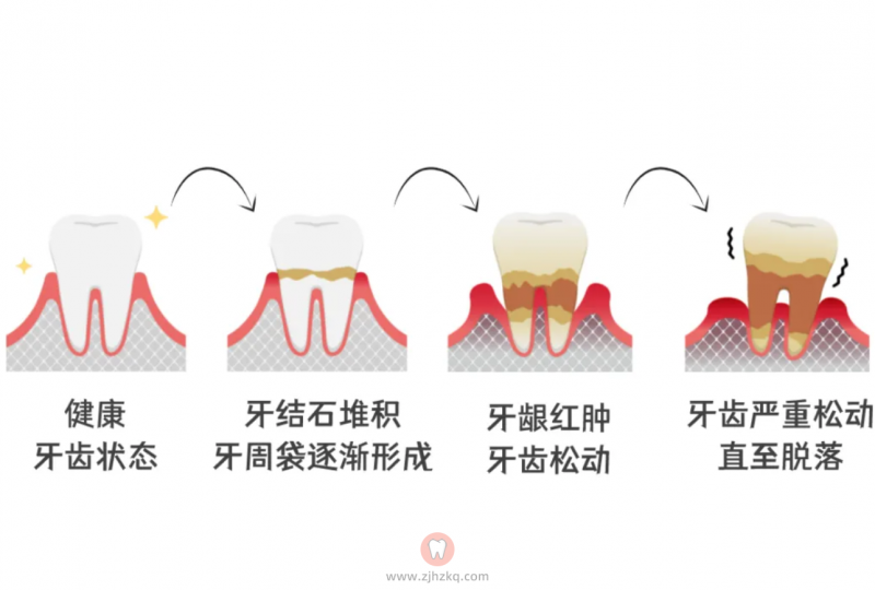 牙周炎能根治吗？为什么？