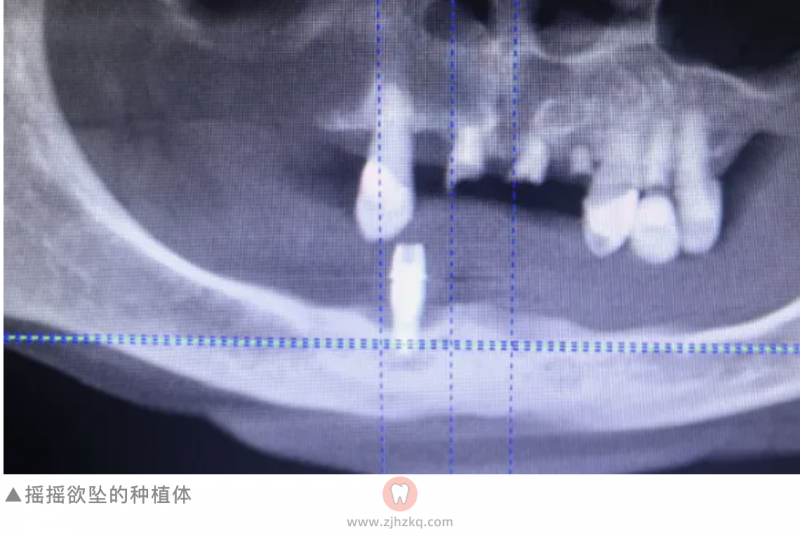 老年人做种植牙陆续掉落四颗（杭口城西谷医生提供）